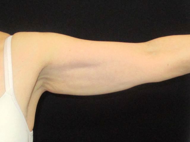 Coolsculpting Before & After