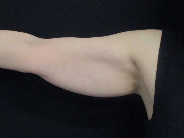 Coolsculpting Before & After