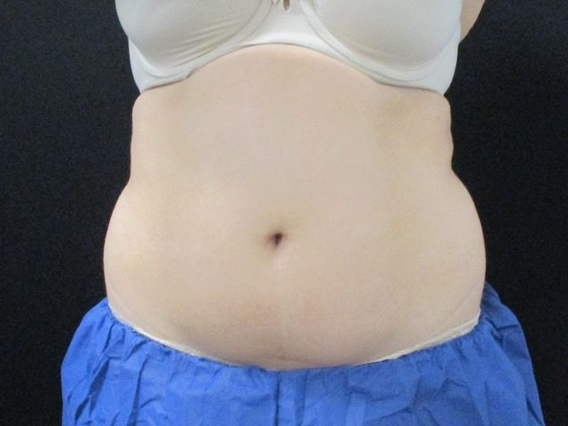 Coolsculpting Before & After
