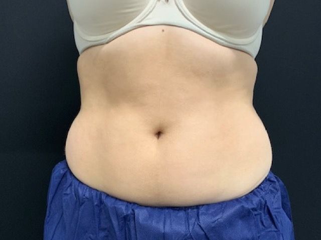 Coolsculpting Before & After