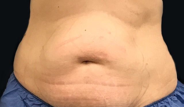 Coolsculpting Before & After