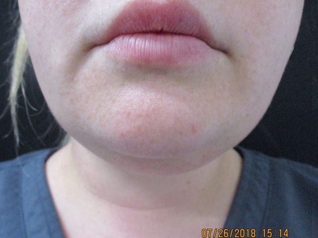 Coolsculpting Before & After