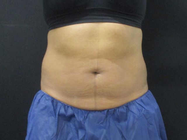Coolsculpting Before & After
