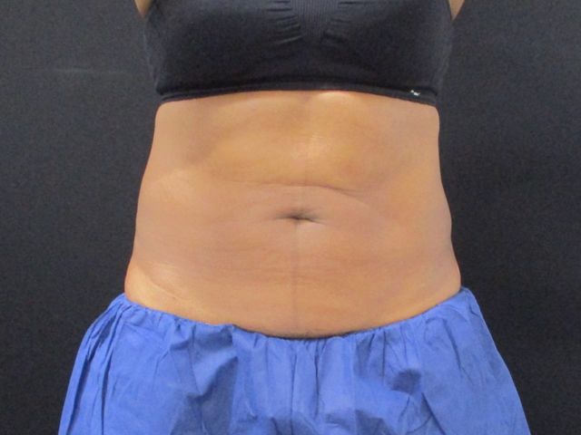 Coolsculpting Before & After