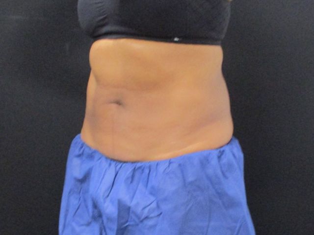Coolsculpting Before & After
