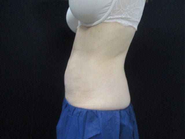 Coolsculpting Before & After