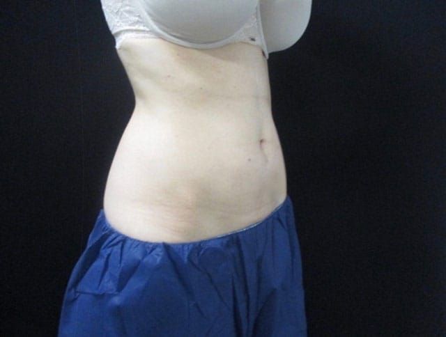 Coolsculpting Before & After