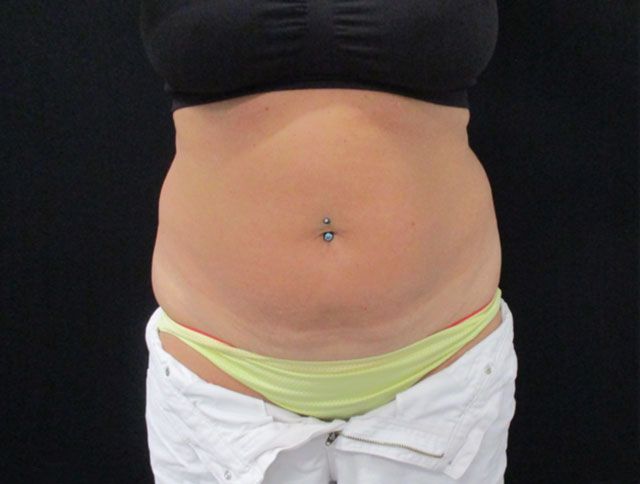 Coolsculpting Before & After