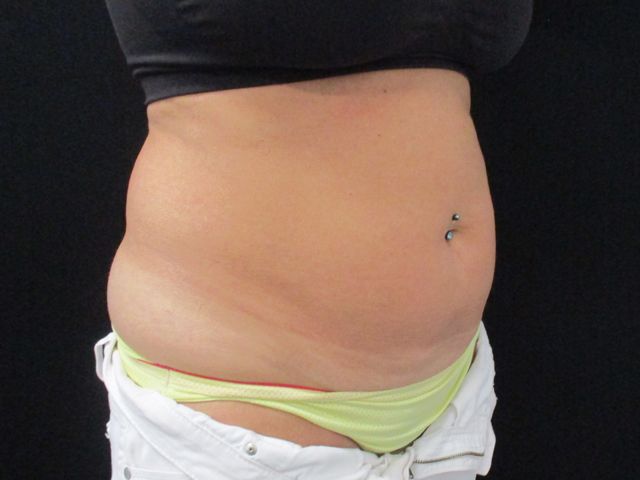 Coolsculpting Before & After