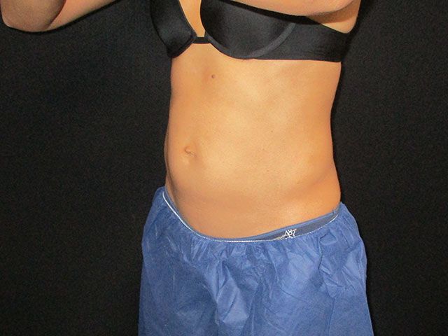 Coolsculpting Before & After