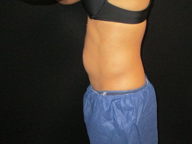 Coolsculpting Before & After