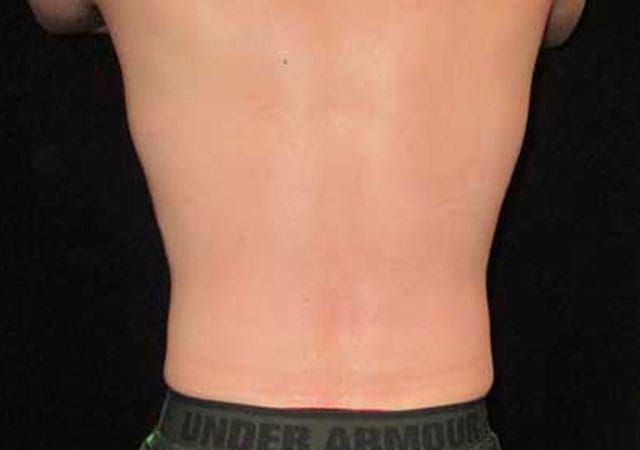 Coolsculpting Before & After