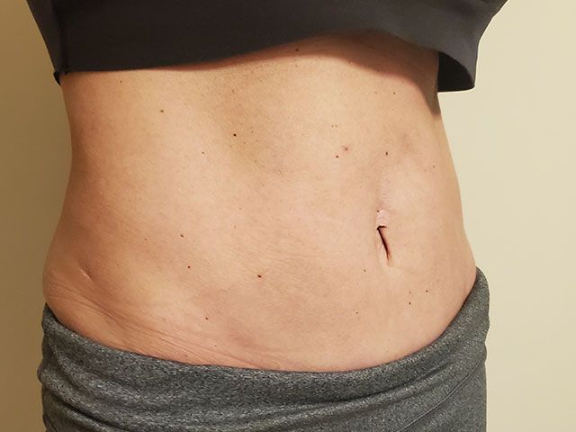 Coolsculpting Before & After