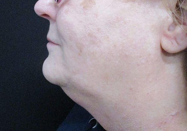 Coolsculpting Before & After