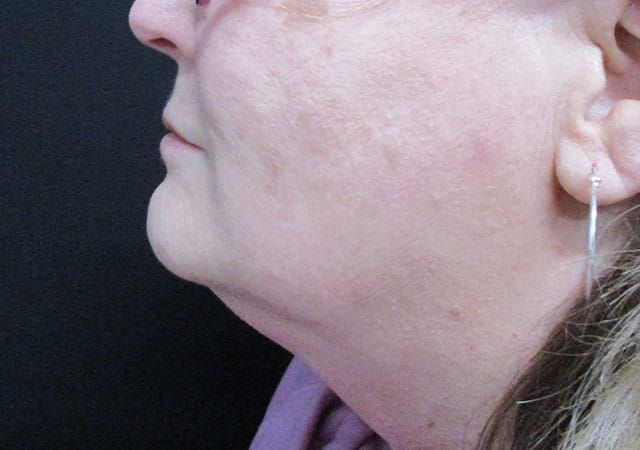 Coolsculpting Before & After