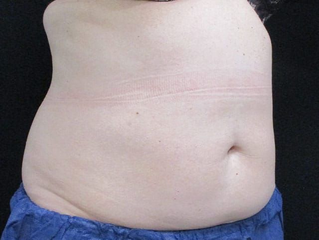 Coolsculpting Before & After