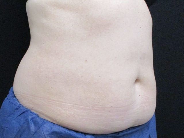 Coolsculpting Before & After