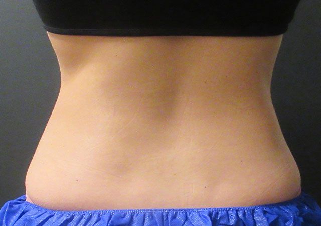 Coolsculpting Before & After