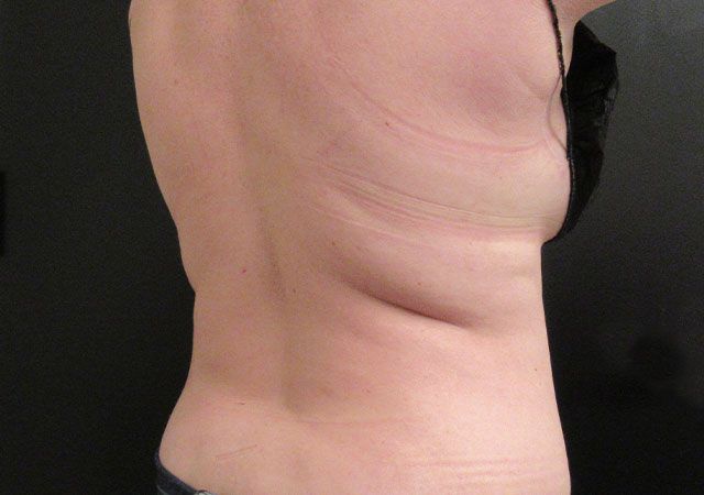 Coolsculpting Before & After
