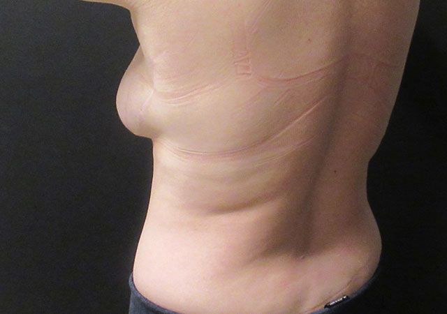 Coolsculpting Before & After