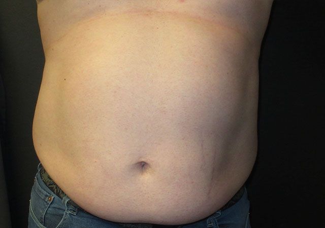 Coolsculpting Before & After