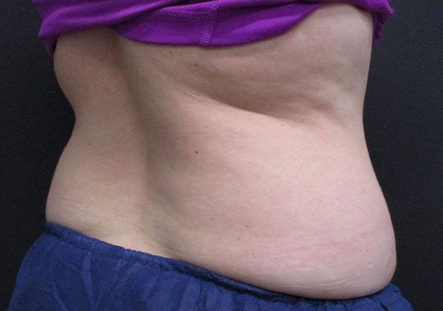 Coolsculpting Before & After