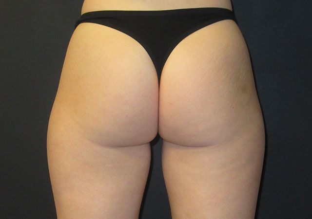 Coolsculpting Before & After