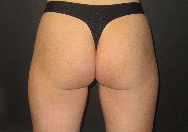 Coolsculpting Before & After