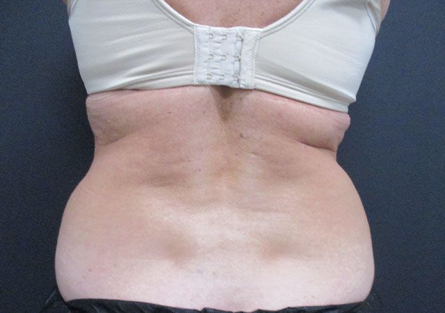 Coolsculpting Before & After