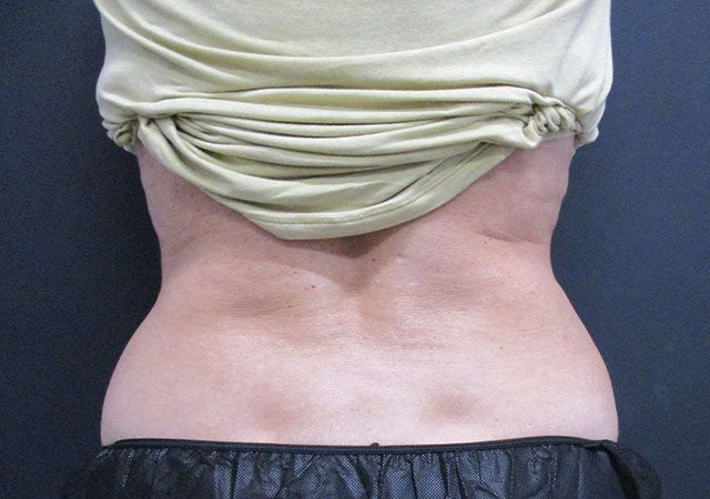 Coolsculpting Before & After