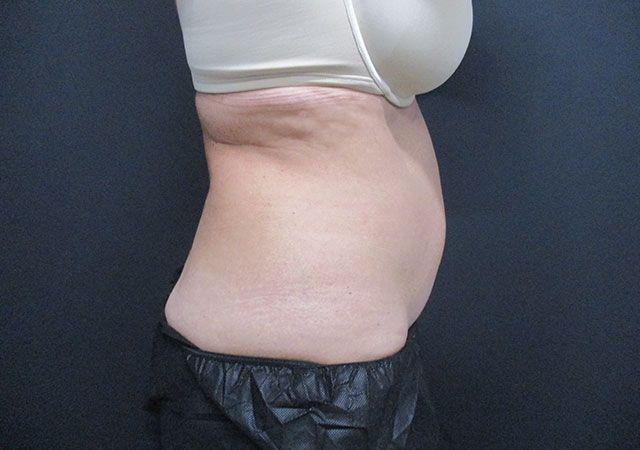 Coolsculpting Before & After