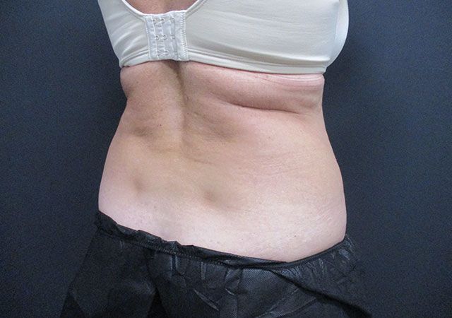 Coolsculpting Before & After