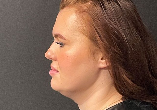 Coolsculpting Before & After