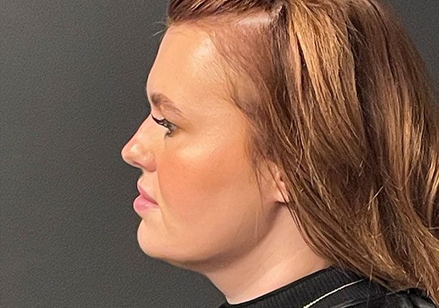 Coolsculpting Before & After