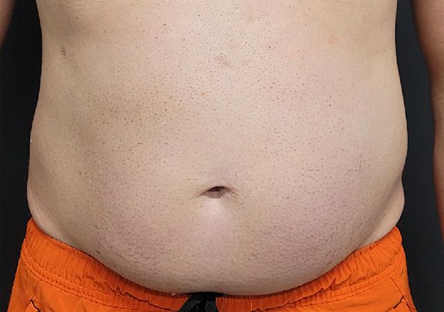 Coolsculpting Before & After