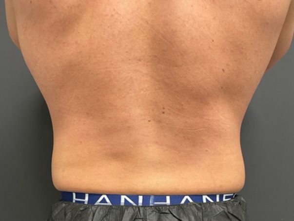Coolsculpting Before & After