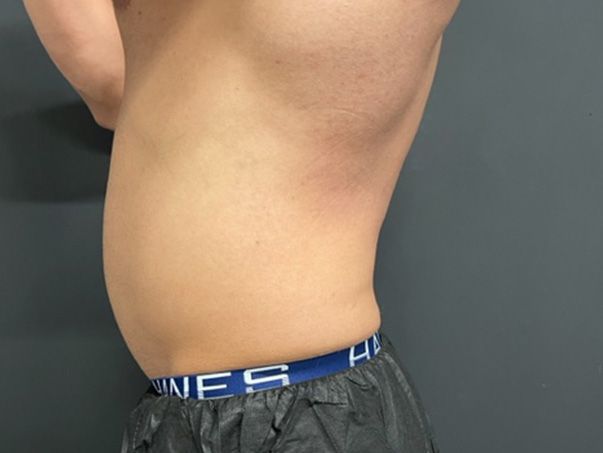 Coolsculpting Before & After