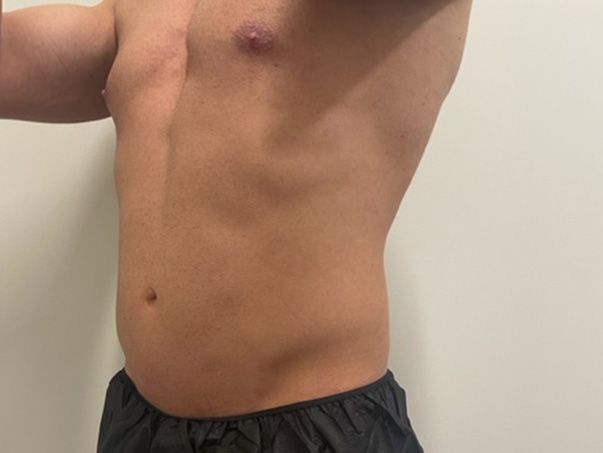 Coolsculpting Before & After