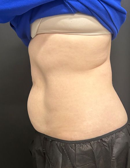 CoolSculpting Before & After