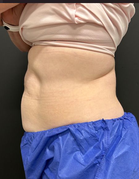 CoolSculpting Before & After
