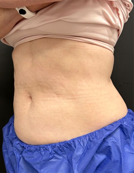 CoolSculpting Before & After