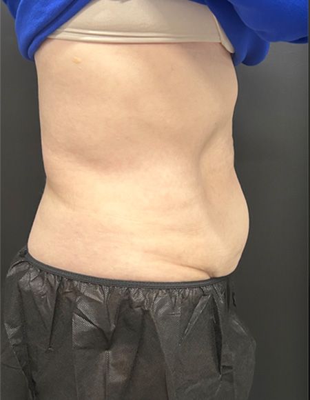 CoolSculpting Before & After