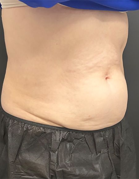 CoolSculpting Before & After