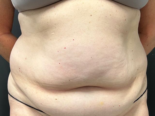 Elite Tummy Tuck Before & After