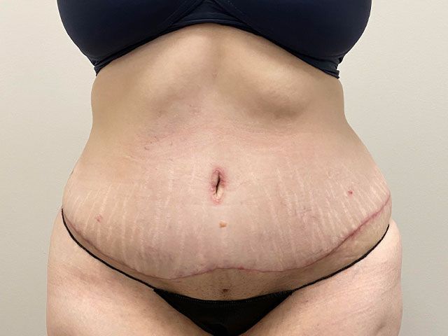 Elite Tummy Tuck Before & After