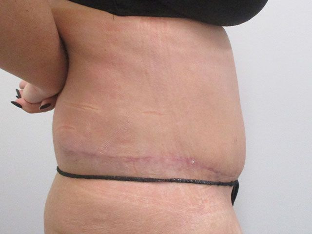 Elite Tummy Tuck Before & After