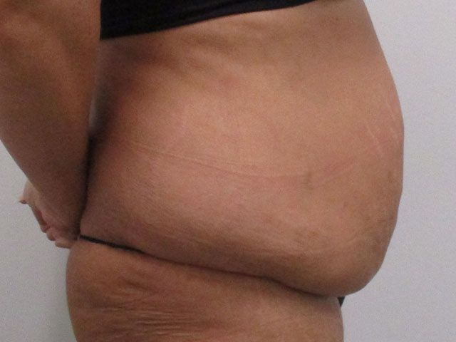 Elite Tummy Tuck Before & After