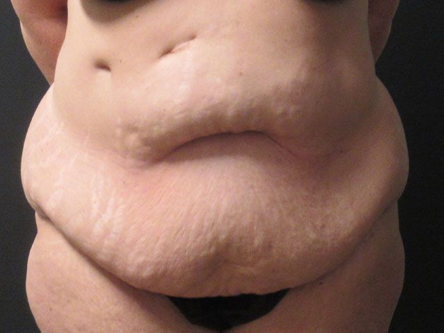 Elite Tummy Tuck Before & After