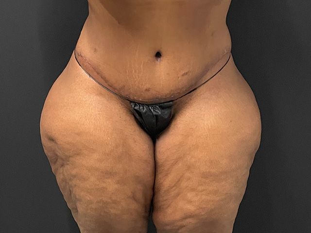 Elite Tummy Tuck Before & After