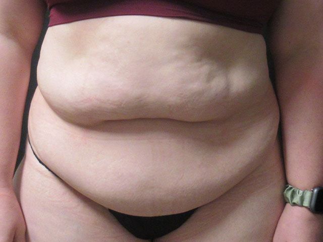 Elite Tummy Tuck Before & After